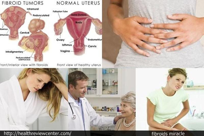 "Say Goodbye to Uterine Fibroids with this One Solution!"