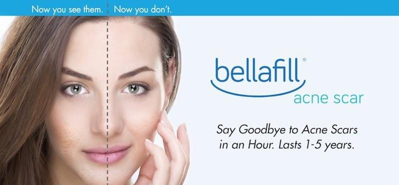 Buy Bellafill https://www.steroidsavengers.org/shop/costmetics/buy-bellafill/